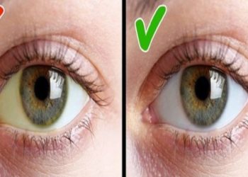 Keni mungesë të vitaminës D? Sytë tuaj i tregojnë simptomat kështu!